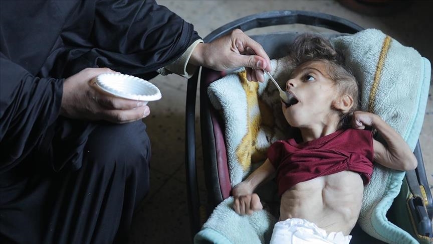 Over 65,000 children in Gaza hospitalized for severe malnutrition: Media office